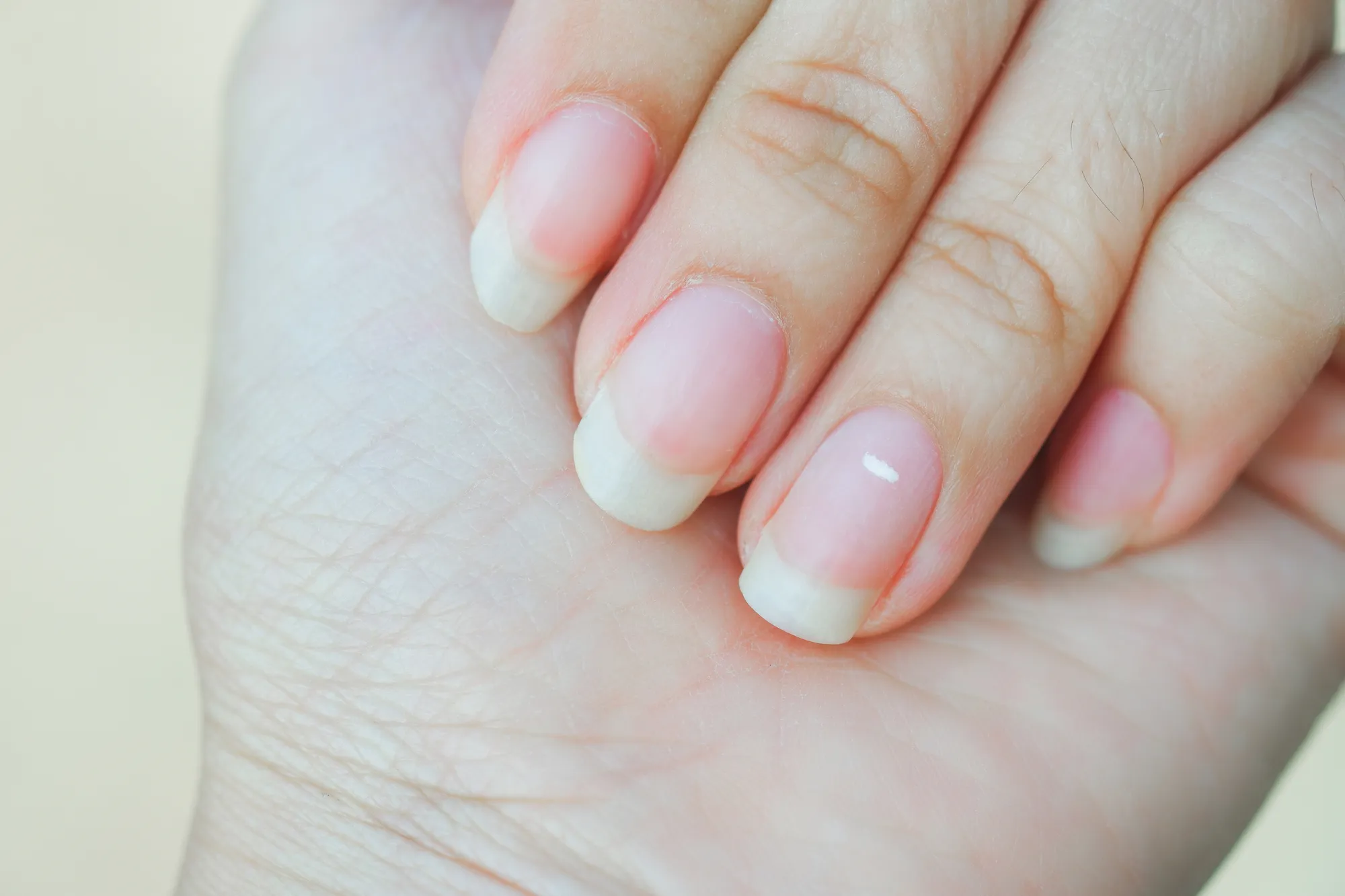 Taches blanches sur les ongles appelées leuconychie